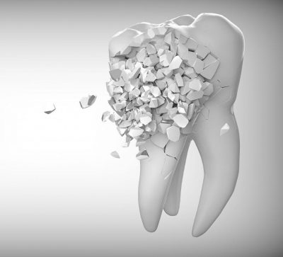 cavity