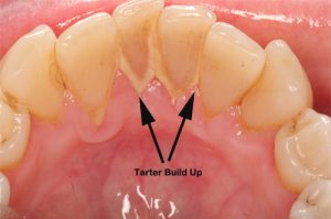 Teeth&Tarter