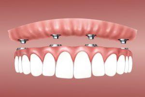 dentalimplants